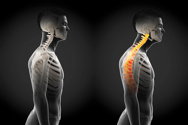 spines, one aligned and one not